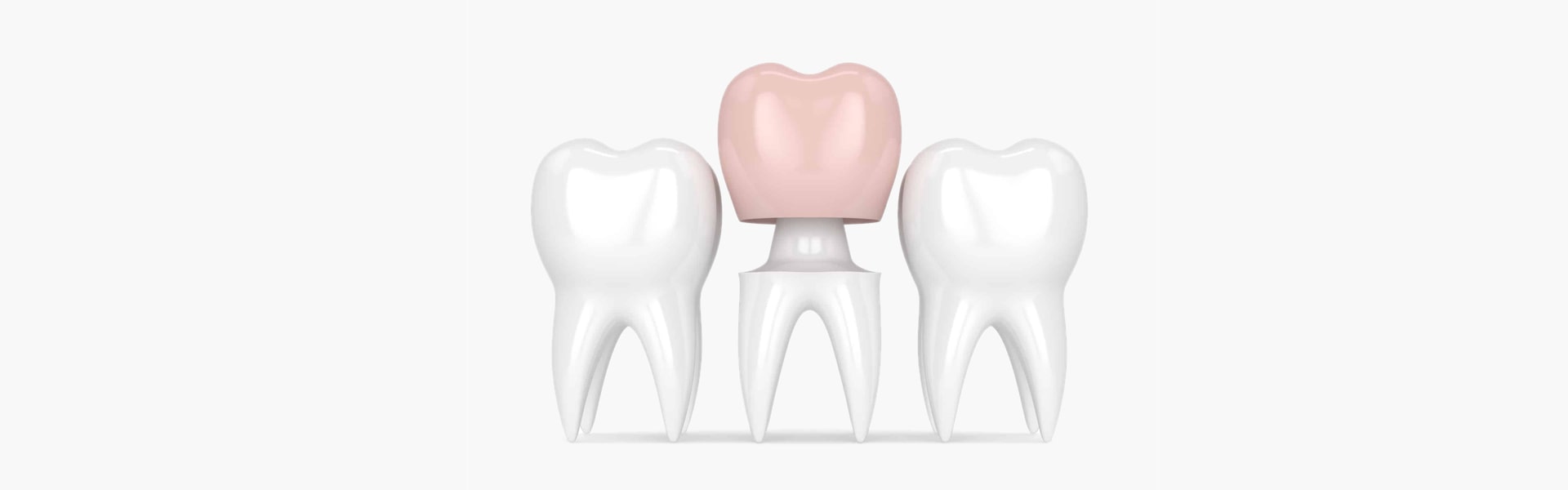 What Are Dental Crowns and Are They Effective?