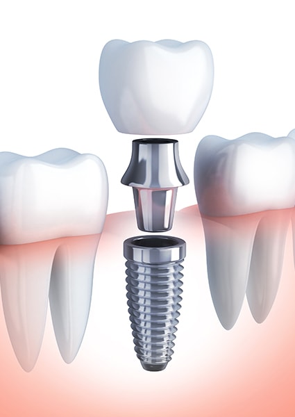 Dental Implant Explanation