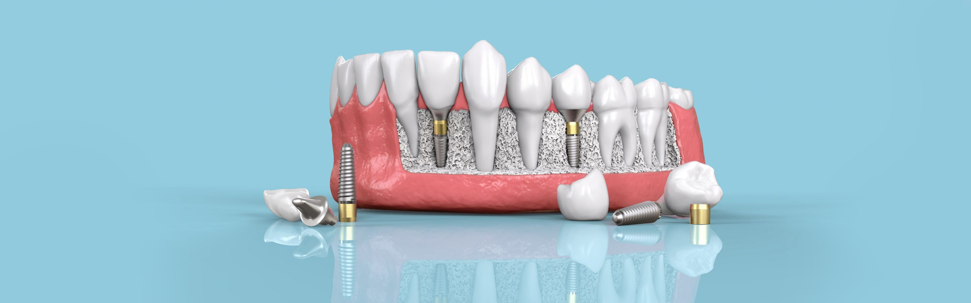 How Do Dental Implants Work?