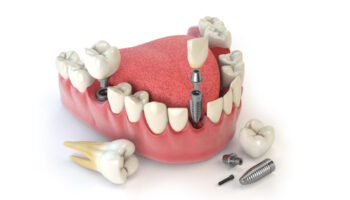 What Are The Different Types of Dentures?