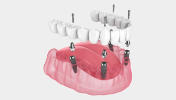 Reasons Why People Choose All on 4 Implants?