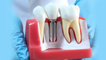 What is the Recovery Process for Dental Implants?