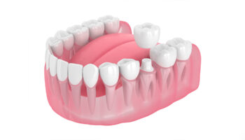 When Do Dentists Recommend Dental Crowns?