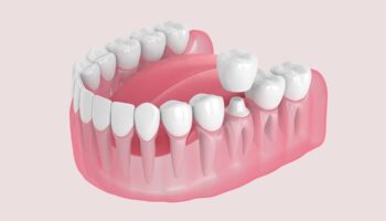 How Long Do Dental Crowns Last?