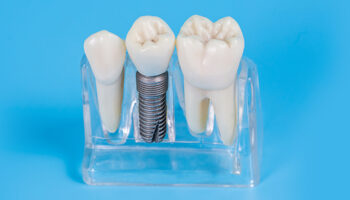 Dental Implants vs Bridges: What’s Better For You?