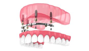 Comparing All-on-4 Implants vs. Traditional Implants