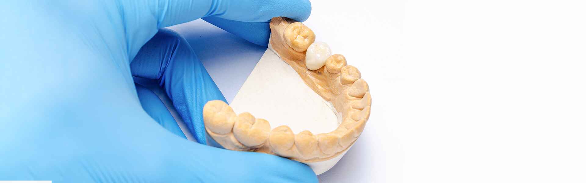 Do Dental Crowns Hurt? What to Expect