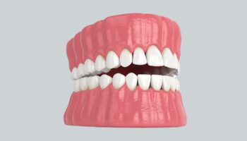 Is It Time for New Dentures? Key Indicators