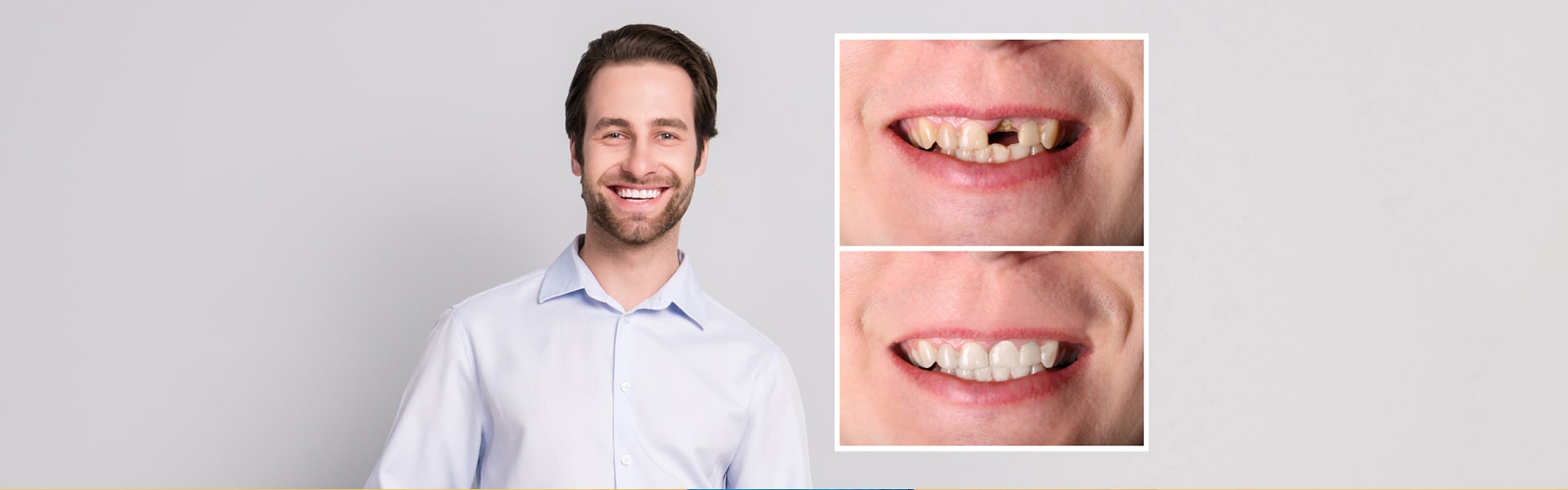 Choosing the Right Dental Crown: Why Material Matters More Than You Think