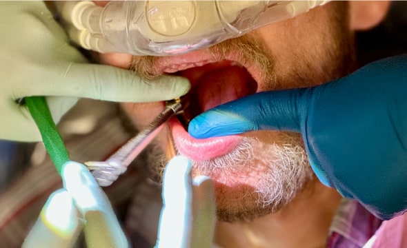 dental implants