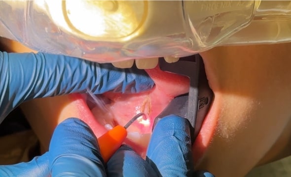 dental laser