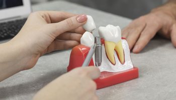 5 Common Myths About Dental Implants Debunked