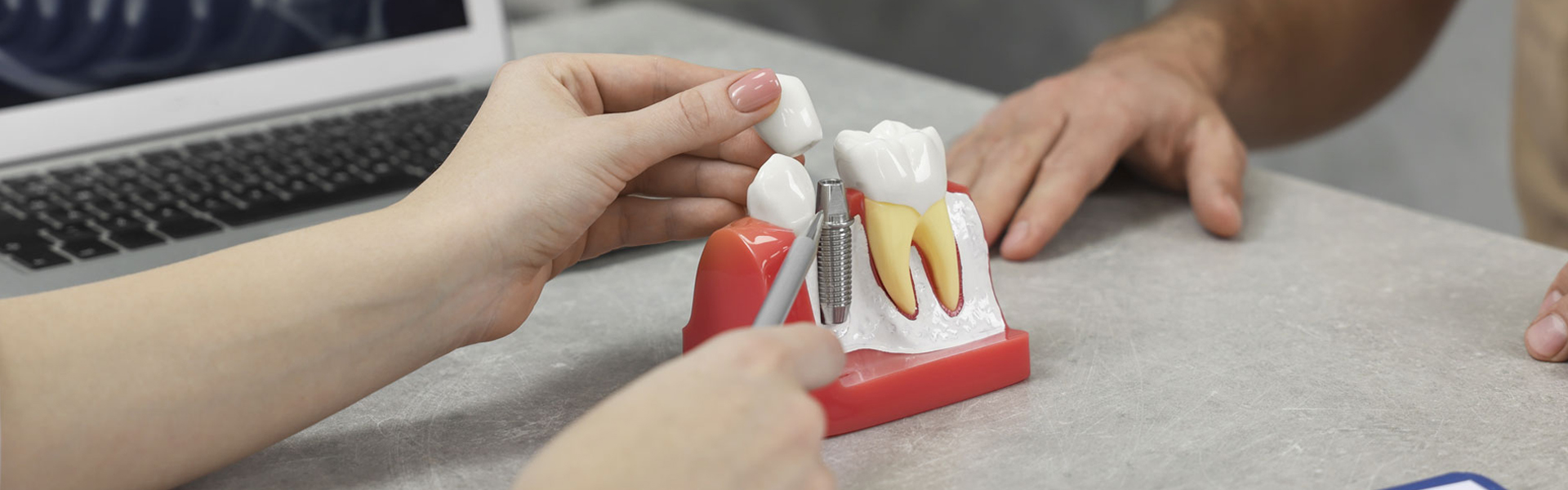 5 Common Myths About Dental Implants Debunked