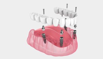 All-on-4: The Efficient Solution for Multiple Tooth Replacement