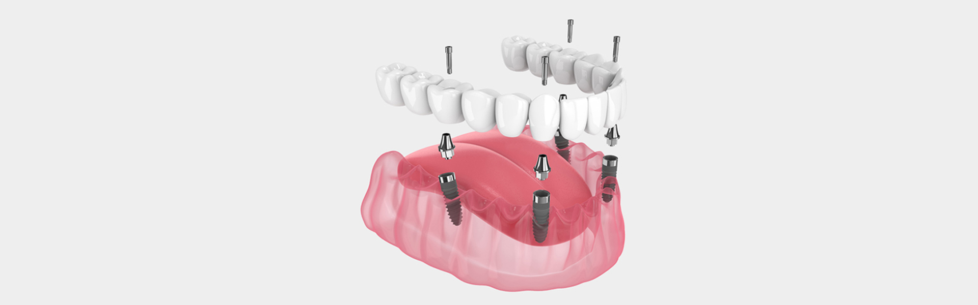 All-on-4: The Efficient Solution for Multiple Tooth Replacement