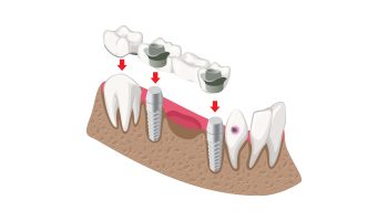 5 Things You Need to Know Before Getting Dental Bridges