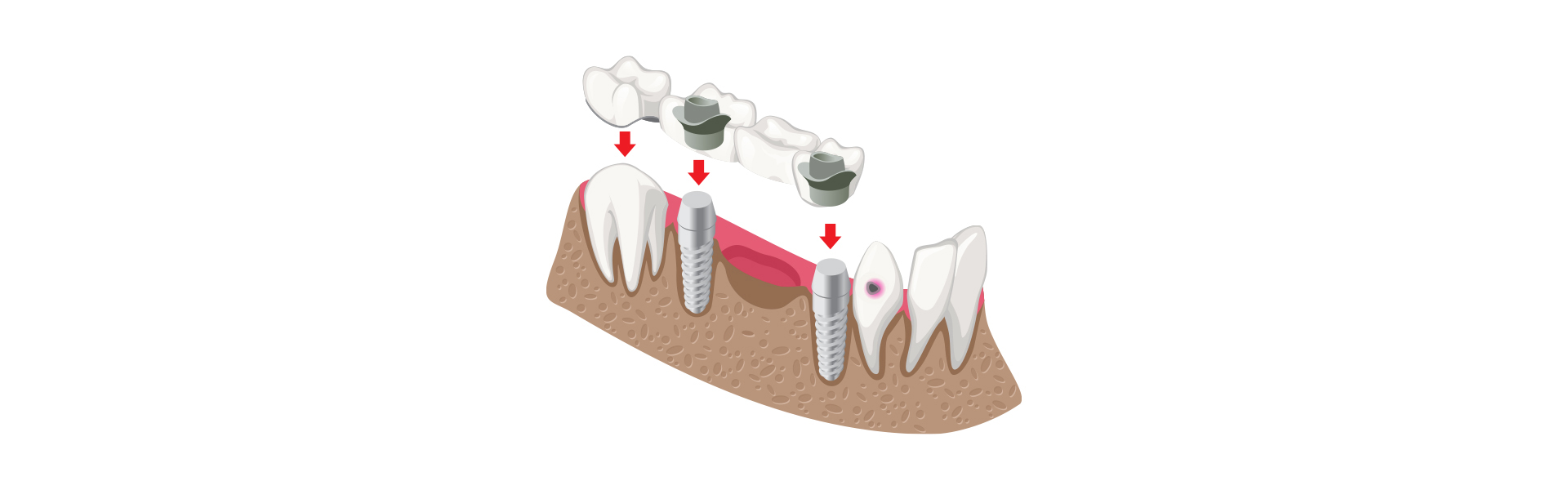 5 Things You Need to Know Before Getting Dental Bridges