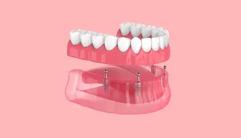 Why All-on-4 Is a Practical Solution for Full Smile Restoration