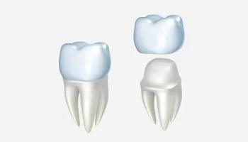 5 Reasons Why Your Dental Crowns May Turn Yellow