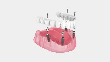 All on 4 Dental Implants for Elderly Patients by a Dentist in Little Elm