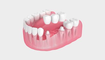 Why Dental Bridges Are a Great Solution for Missing Teeth