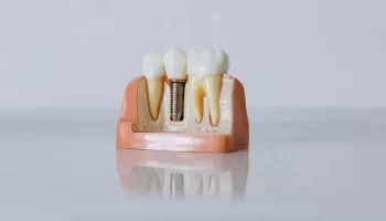 Get Back Your Chewing Ability with Dental Implants in Little Elm